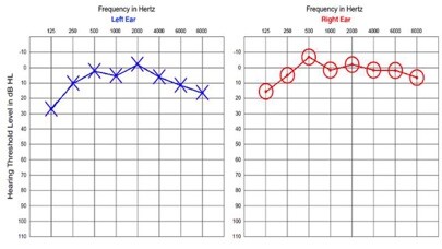 Emulate iPhone app Audiogram Hearing Test using MyAndroid