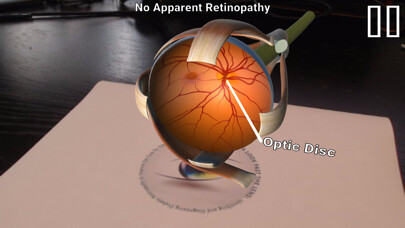 Emulate iPhone app Diabetic Retinopathy AR using MyAndroid Emulate iPhone app Diabetic Retinopathy AR using MyAndroid