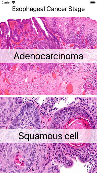 Emulate iPhone app Esophageal Cancer Stage using MyAndroid Emulate iPhone app Esophageal Cancer Stage using MyAndroid