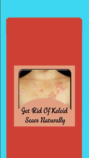Run android online APK Get Rid Of Keloid Scars Naturally from MyAndroid or emulate Get Rid Of Keloid Scars Naturally using MyAndroid Run android online APK Get Rid Of Keloid Scars Naturally from MyAndroid or emulate Get Rid Of Keloid Scars Naturally using MyAndroid