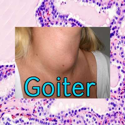 Emulate Android APK Goiter Emulate Android APK Goiter