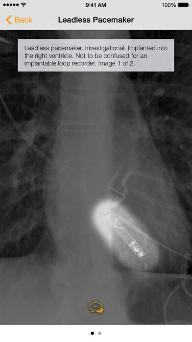 Emulate iPhone app Medical Devices on Chest X-Ray using MyAndroid Emulate iPhone app Medical Devices on Chest X-Ray using MyAndroid