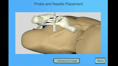 Emulate iPhone app Regional Anesthesia Assistant for iPhone using MyAndroid Emulate iPhone app Regional Anesthesia Assistant for iPhone using MyAndroid