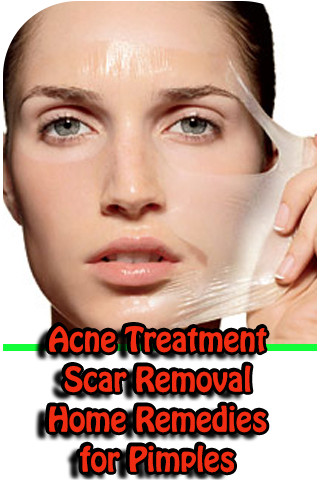 Emulate Android APK Remedies for Pimples, Acne Treatment, Scar Removal Emulate Android APK Remedies for Pimples, Acne Treatment, Scar Removal