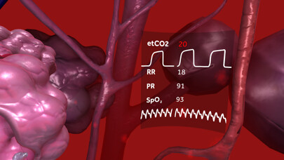 Emulate iPhone app Respiratory Compromise: Journey to the Lungs using MyAndroid Emulate iPhone app Respiratory Compromise: Journey to the Lungs using MyAndroid