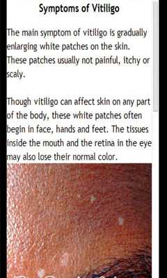 Emulate Android APK Vitiligo Handbook Emulate Android APK Vitiligo Handbook